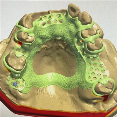 Kann das zahnmedizinische digitale Metallrahmendesign in der präventiven Zahn...